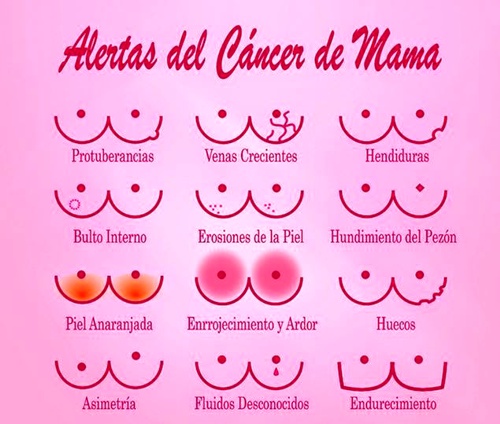 Cáncer de mama - Secretaría de Salud del Cauca Cáncer de mama - Cauca