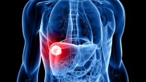 Cáncer de higado Cáncer de higado