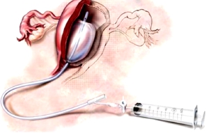 Ligadura de trompas - obstetricia Ligadura de trompas - obstetricia