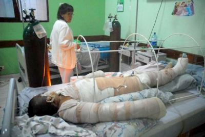 Quemado con pólvora Quemado con pólvora