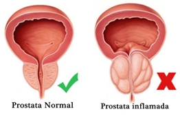 Prevenga el Cáncer de Próstata Prevenga el Cáncer de Próstata