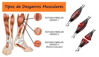 Clínica de la lesión de James Rodríguez