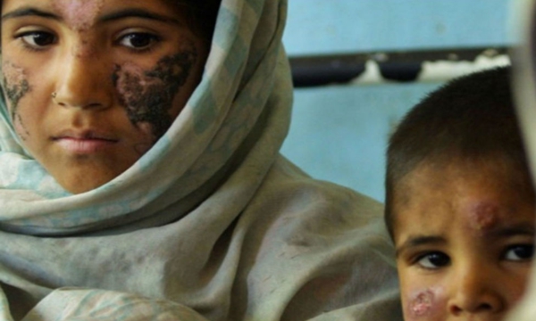 EPM y la leishmaniasis