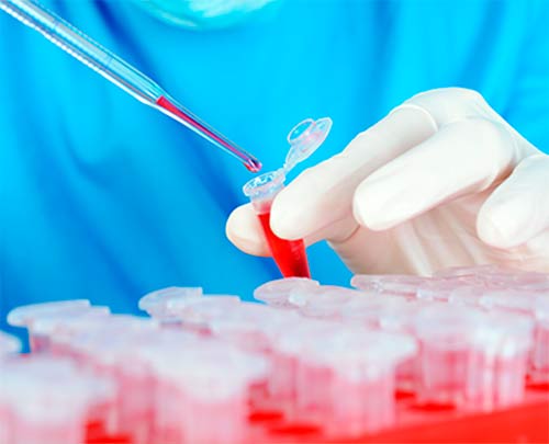 La Mielofibrosis, un cáncer raro y silencioso de la sangre La Mielofibrosis, un cáncer raro y silencioso de la sangre