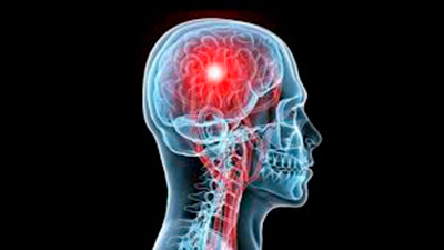 Accidente cerebrovascular: la clave es identificarlo y actuar a tiempo Accidente cerebrovascular: la clave es identificarlo y actuar a tiempo