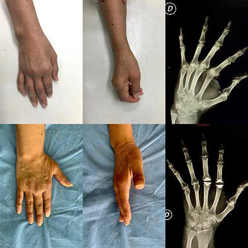 Hospital San José ya cuenta con el servicio de Cirugía de Mano y Microcirugía Hospital San José ya cuenta con el servicio de Cirugía de Mano y Microcirugía