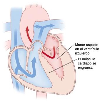 Cardiomiopatía hipertrófica - Enfermedades del corazón Cardiomiopatía hipertrófica - Enfermedades del corazón