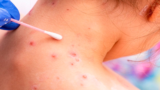 Alerta epidemiológica por sospecha de viruela símica en Popayán Alerta epidemiológica por sospecha de viruela símica en Popayán
