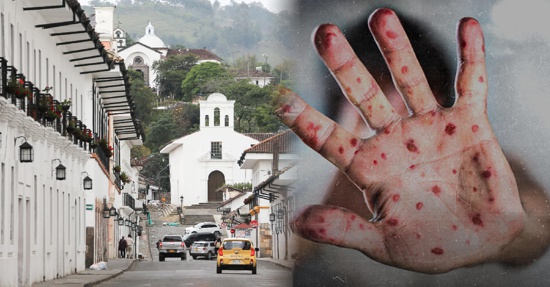 Confirman primer caso de viruela símica en Popayán Confirman primer caso de viruela símica en Popayán