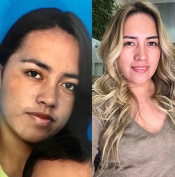 Caucana lidera investigación para la cura del vitiligo