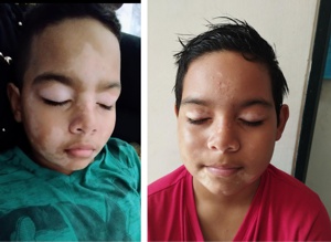 La caucana Leidy Peña lidera investigación para la cura del vitiligo