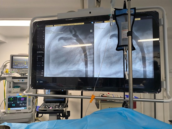 Milagro médico en Popayán: primer procedimiento de Cierre de Ductus en paciente pediátrico. Milagro médico en Popayán: primer procedimiento de Cierre de Ductus en paciente pediátrico.